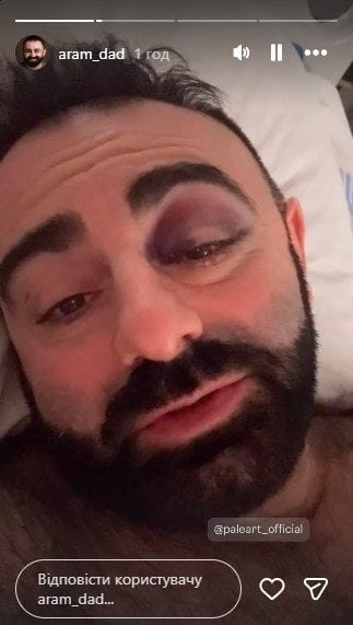 Арам Арзуманян травмував череп під час вистави в Харкові