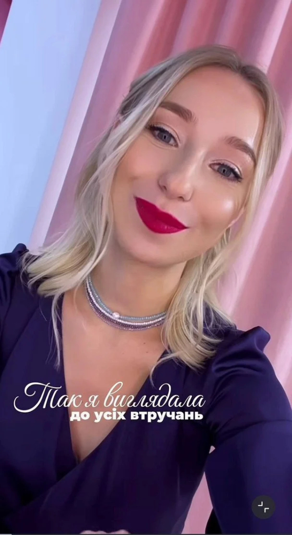 Катерина Реп'яхова до пластики