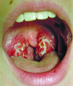 Фарингіт з’являється після застуди та вірусних інфекцій. На відміну від ангіни запалене горло не болить. Температура сильно не підвищується
