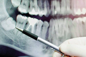 Зуб мудрості, який не виростає або росте вбік, пошкоджує інші зуби, викликає запалення