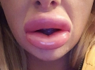 Девушка неудачно увеличила губы у "домашнего косметолога"
