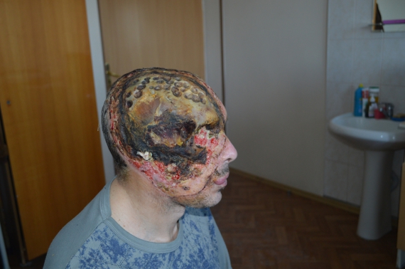 Чоловік з Сум обпалив пів обличчя