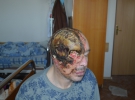 Чоловік з Сум обпалив пів обличчя