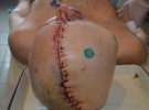 Хірурги пересадили клапоть шкіри 20Х30 см