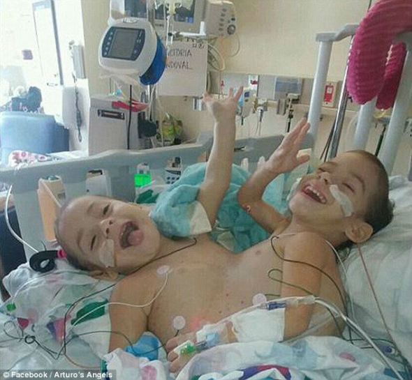 Сиамских близнецов разделили в больнице Пало Альто