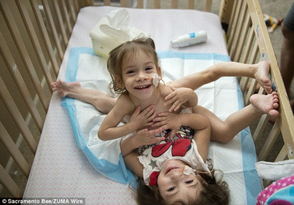 Сиамских близнецов разделили в больнице Пало Альто