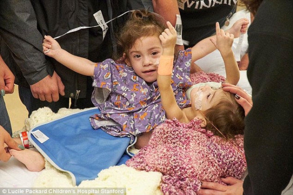 Сіамських близнят розділили в лікарні Пало Альто
