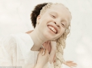 Одна из сестер близняшек-альбиносов