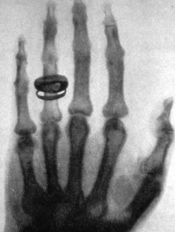 Перший рентгенівський знімок. Рука дружини Вільяма Рентгена. 