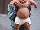 Восьмимісячна Чахат Кумар з Індії важить 20 кілограмів