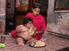 Восьмимесячная Чахат Кумар из Индии весит 20 килограм