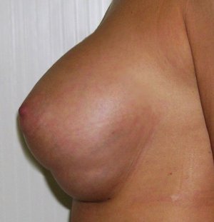 Щоб не виникло ускладнень після операції по збільшенню грудей, рекомендують не піднімати важке і не навантажувати плечі