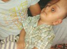 Пакистанському хлопчику Ібтісам Фейсалу зменшили голову на 12 см