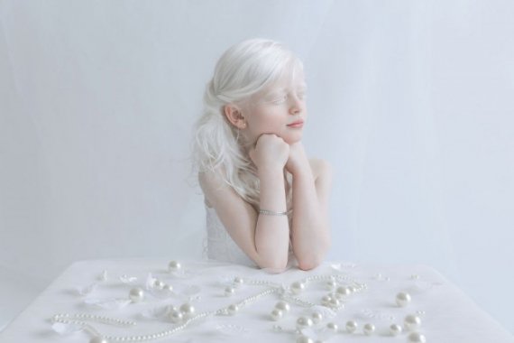Фото детей-альбиносов