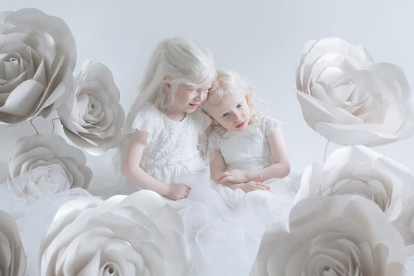 Фото детей-альбиносов