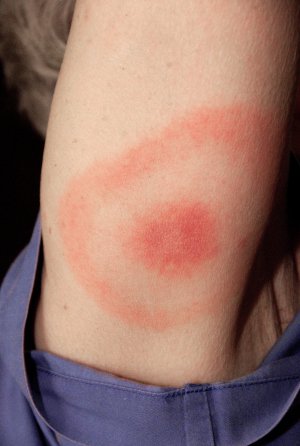 Хворобу Лайма діагностують за появою на шкірі почервоніння у вигляді кільця. Воно має 5–6 сантиметрів у діаметрі