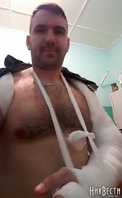 Депутат Руслан Нерода, якому зламали руку