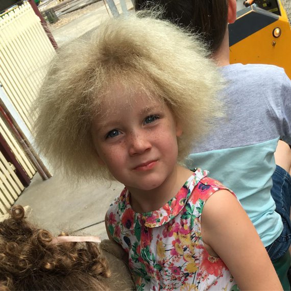 Унікальна дитина: у дівчинки росте волосся, яке неможливо розчесати