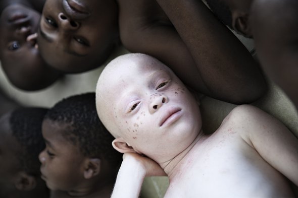 Фотопроект на захист дітей-альбіносів у Танзанії