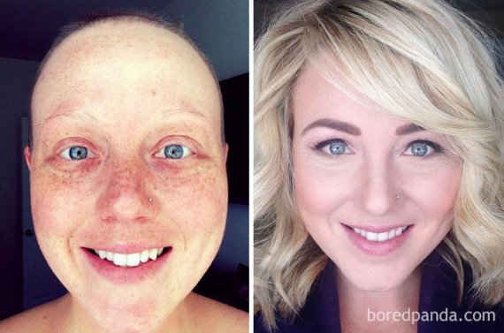 Як жити після раку: фото людей, які перемогли хворобу