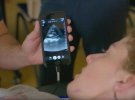 Butterfly iQ – невеликий ультразвуковий апарат, який виводить чорно-біле зображення прямо на екран смартфона