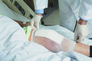 До руйнування суглобів призводять артрози, ревматоїдні артрити, переломи