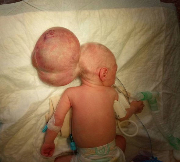 Младенцу сделали две операции, чтобы удалить грыжу головного мозга