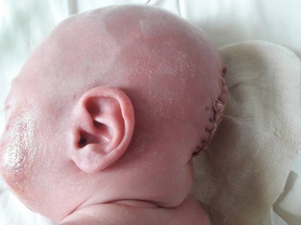 Немовляті зробили дві операції, щоб видалити грижу головного мозку