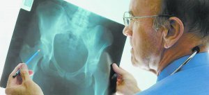 Остеопороз найчастіше буває у жінок після 50 років і у чоловіків старших 70