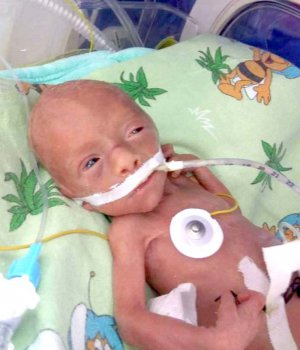 Вінницькі лікарі провели унікальну операцію: немовля дістали в навколоплідному міхурі 