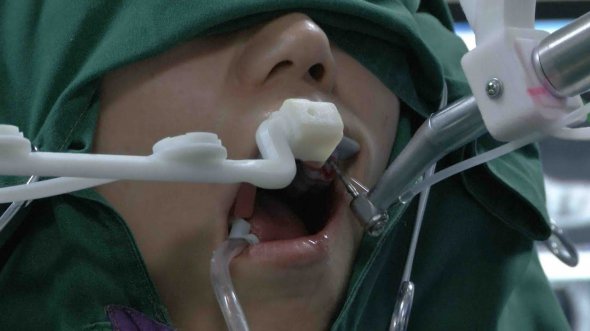 Розроблений в Китаї робот-стоматолог вперше прооперував пацієнта без участі лікарів