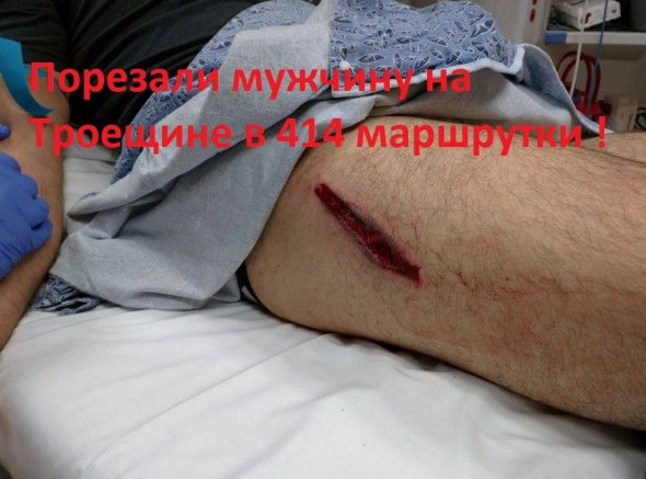 В Деснянском районе Киева мужчина порезал ножом ногу пассажиру из-за конфликта в маршрутке