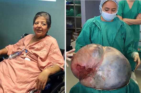 Сони Лопес вырезали 34-килограммовую опухоль, которая росла 8 лет
