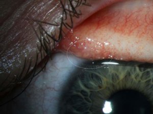Воспаленный глаз Бекли во время заболевания