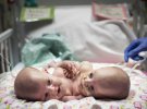 Лікарі готувалися до операції над близнючками протягом 11 місяців