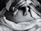 Крошечные ножки малыша над шрамом, который мать получила во время предыдущих родов путем Кесарева сечения