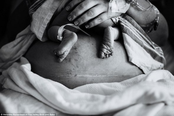 Крихітні ніжки малюка над шрамом, який мати отримала під час попередніх родів шляхом Кесаревого розтину
