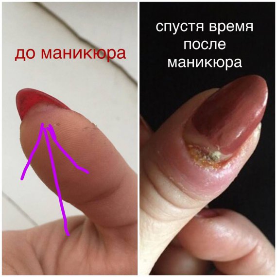 Запорізька спорстменка Євгенія Самойлова втратила ніготь, який загнив після манікюру в салоні краси