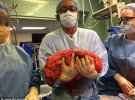 Кевину Дейли вырезали 13-килограммовую опухоль