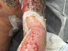 Лікарі вимушені були видалити частину татуювання разом зі шкірою