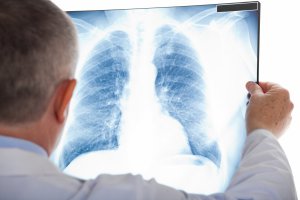 Медики розповіли, хто частіше хворіє туберкульозом