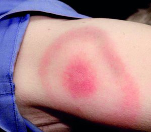 Кліщі викликають хворобу Лайма. Для неї характерна пляма у вигляді концентричних кругів. На відміну від інших укусів, вона з часом збільшується