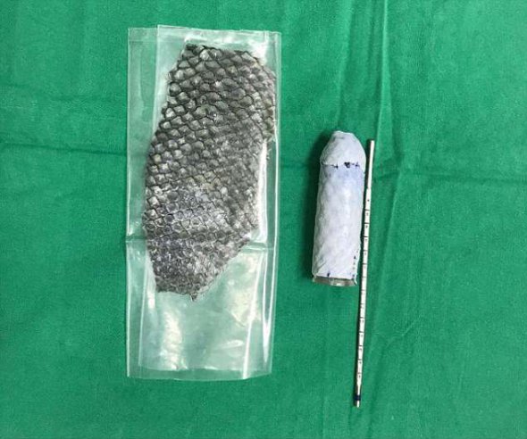 Команда врачей использовала обработанную кожу пресноводной рыбы тиляпии