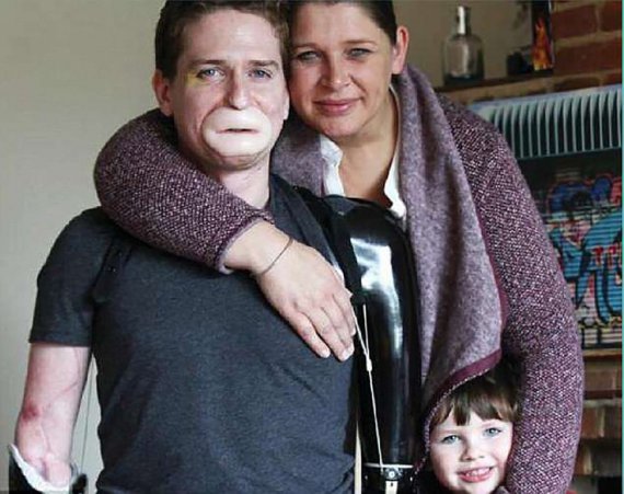 38-річний Алекс Льюіс втратив руки, ноги і частину обличчя внаслідок інфекції.