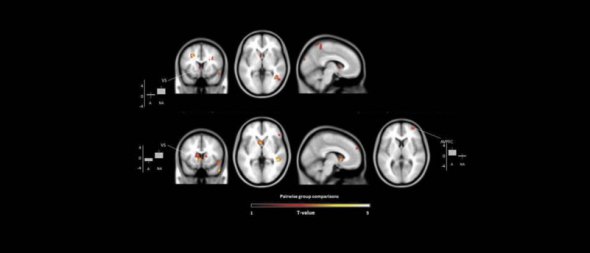 Результаты сканирования мозга для исследования Creativity Research Journal