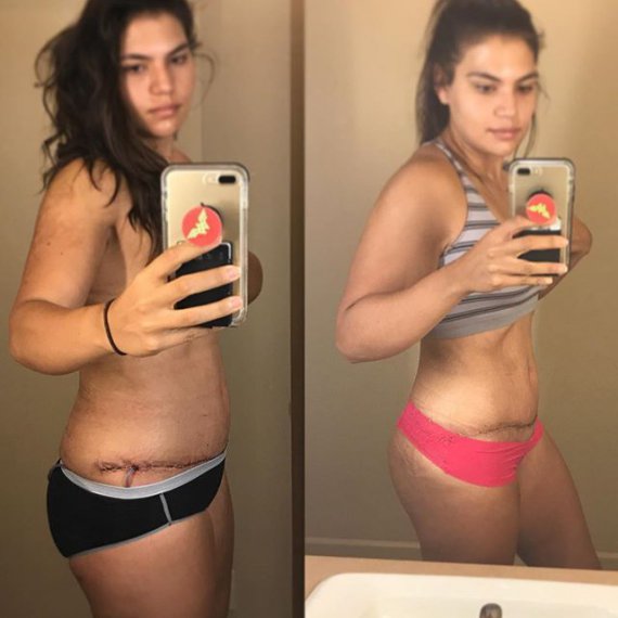 24-летняя Лора Микетич за год похудела на 50 кг