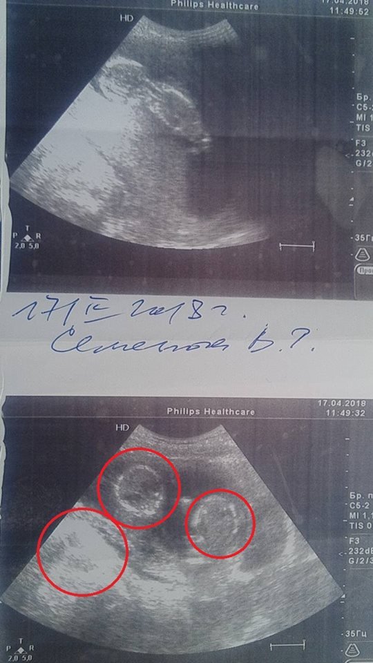 Мешканка міста Верхньодніпровськ 17-річна Вікторія незабаром має народити трійнят