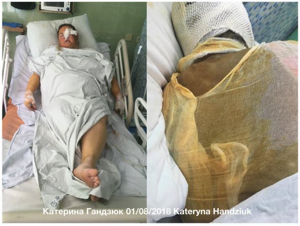 Працівниця Херсонської міської ради Катерина Гандзюк знаходиться на лікуванні у Києві після нападу  