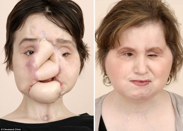 Кэти Стаблфилд до и после пересадки лица