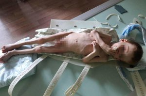 Виснаженого голодом Владислава Мольченка з міста Новоукраїнка на Кіровоградщині забрали до лікарні. У 3 роки і 10 місяців важить сім кілограмів — майже у півтора рази менше норми